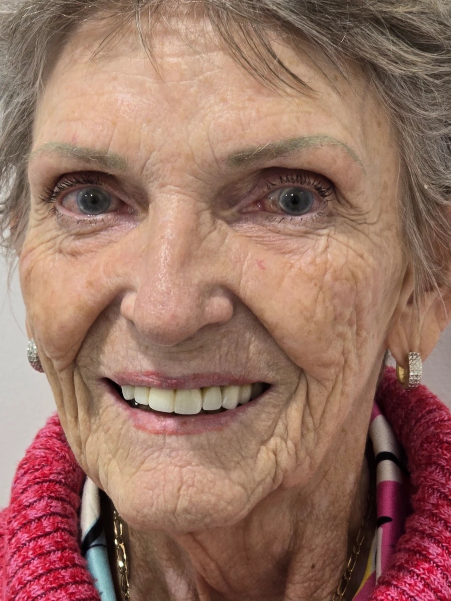 Patient 1 — after porcelain veneers