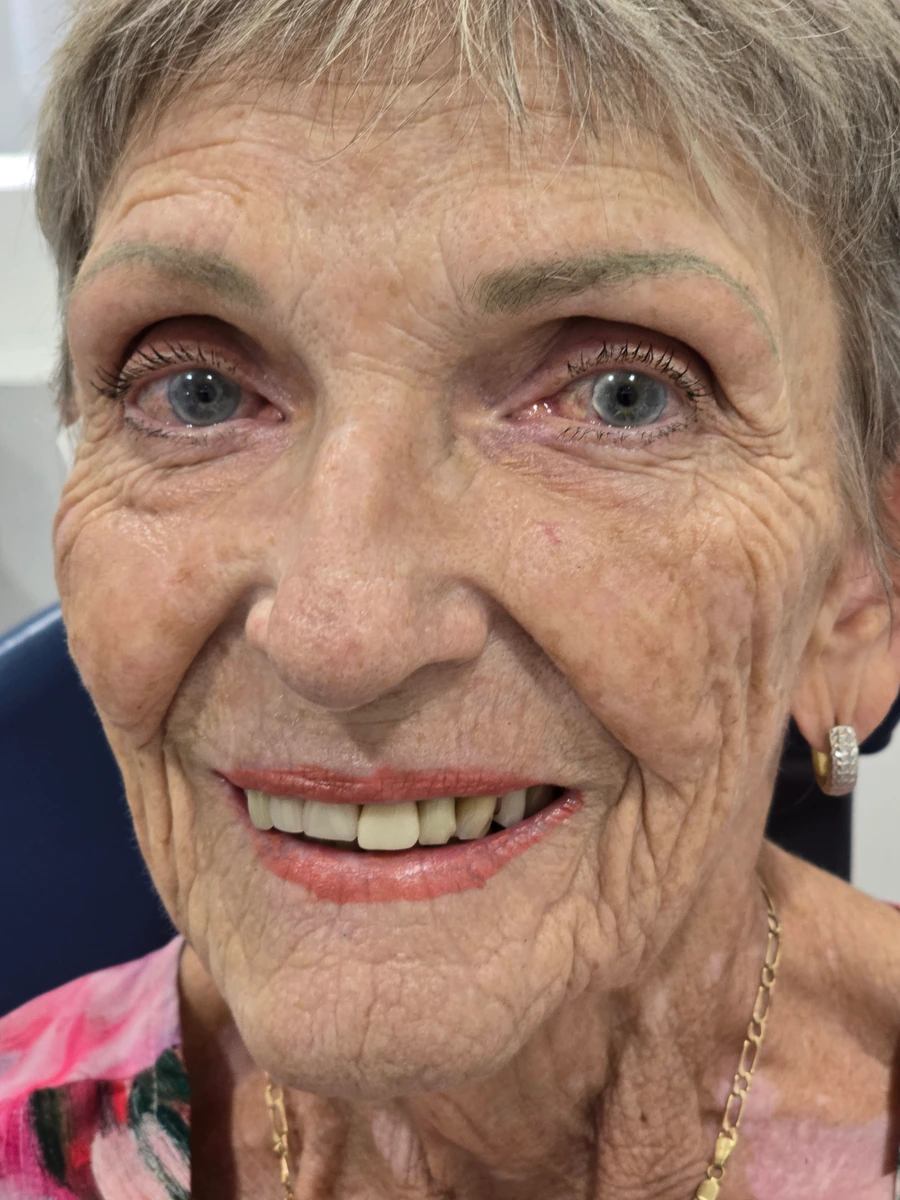 Patient 1 — before porcelain veneers