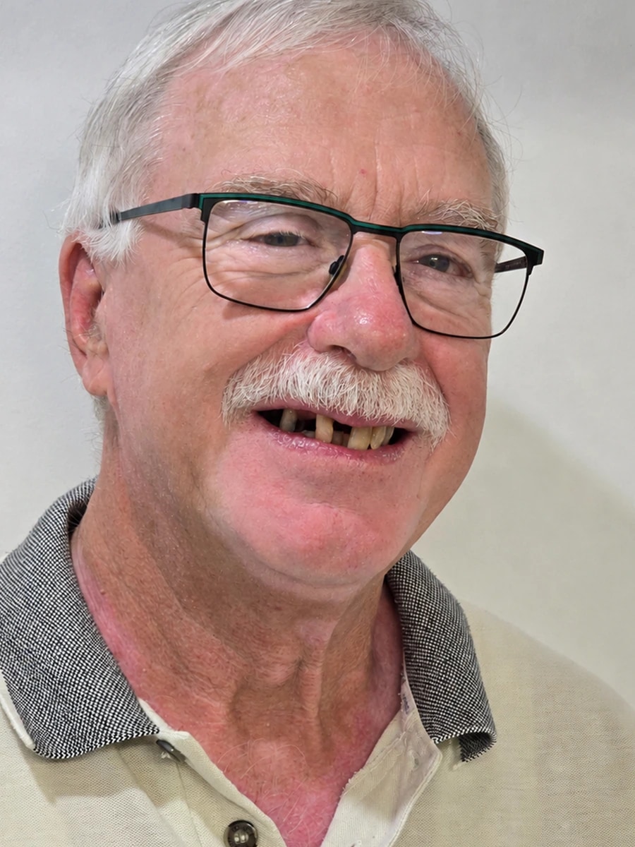 Patient 3 — before porcelain veneers